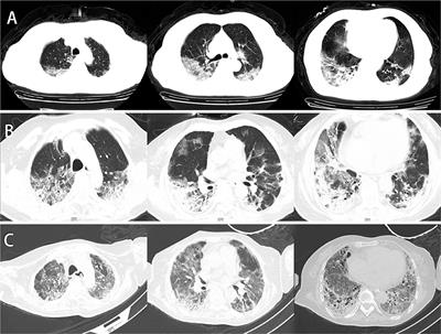 Case Report: Human Umbilical Cord Mesenchymal Stem Cells as a Therapeutic Intervention for a Critically Ill COVID-19 Patient